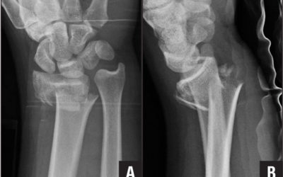 L’utilisation de la thérapie miroir pour les fractures distales du radius : une étude pilote contrôlée randomisée